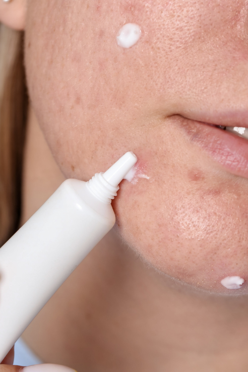 Acne Target Treatment